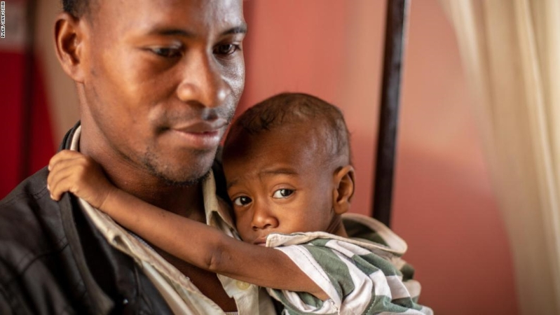 Epidemija morbila na Madagaskaru uzela preko 900 života